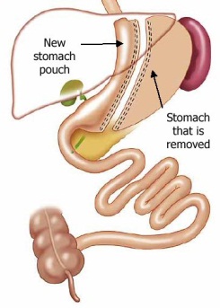 gastricsleeve-victoriabariatricsurgery.com